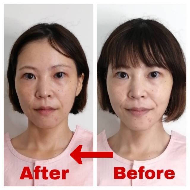 美容鍼の施術前後の比較写真1