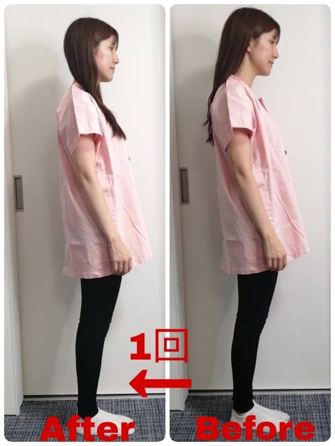 美容鍼の施術前後の比較写真10
