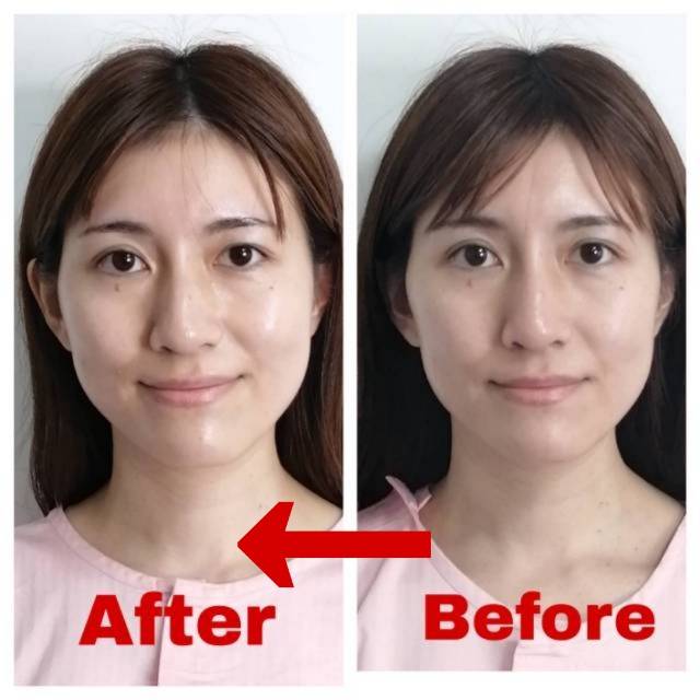 美容鍼の施術前後の比較写真2