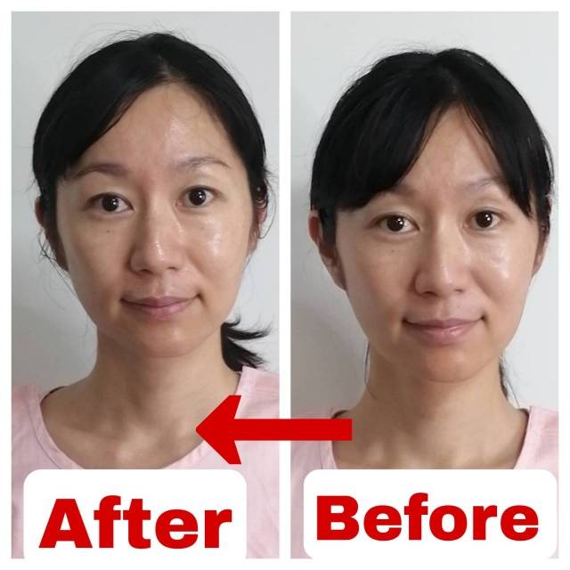 美容鍼の施術前後の比較写真3