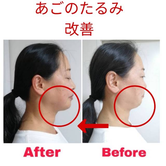 美容鍼の施術前後の比較写真4