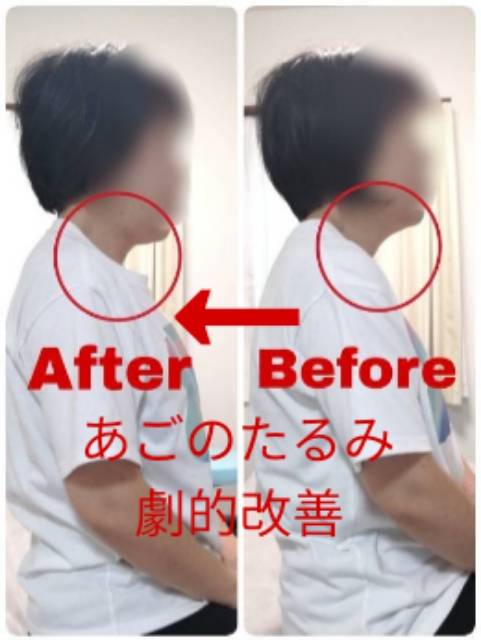 美容鍼の施術前後の比較写真6